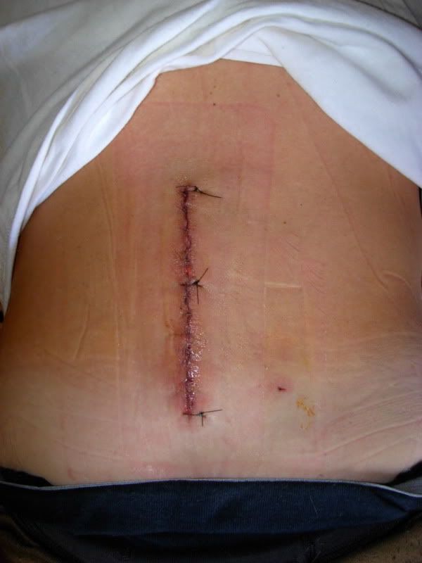 backsurgery230001.jpg