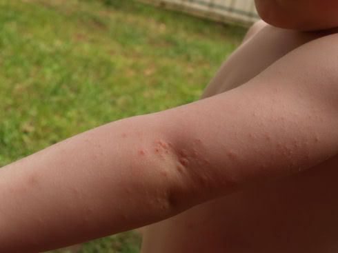 Itchy Bumps Elbow